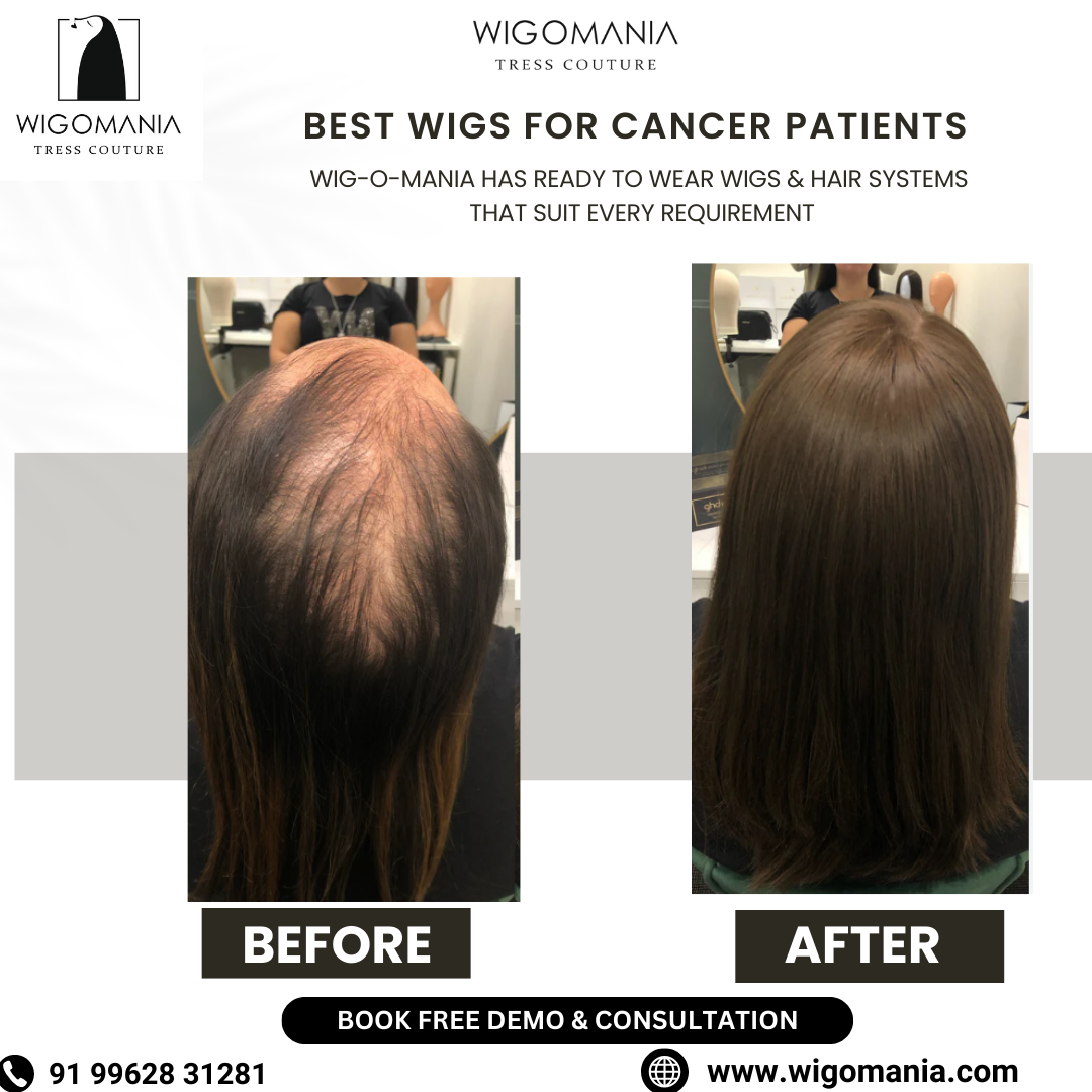 Best Wigs for Cancer Patients in Hyderabad: A Complete Buying Guide